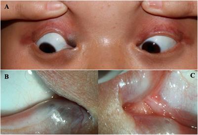 Case report: ADULT syndrome: a rare case of congenital lacrimal duct abnormality